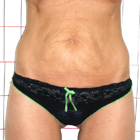 Antes abdominoplastia