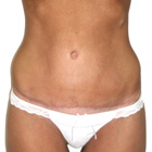 Después abdominoplastia