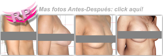 Aumento Mamario Fotos antes después