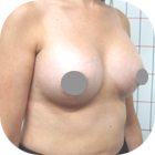 Después de implantes mamarios