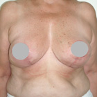 Cicatrices en curación posteriores a la reducción mamaria con levantamiento mamario; ver el antes