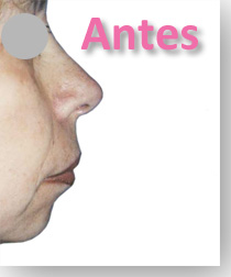 Mentoplastía, fotos antes-después