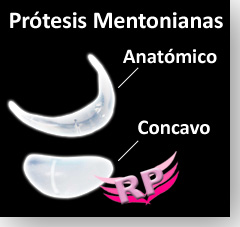 Tipos de implante de mentón para mentoplastía