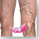 Varicose veins before after photos