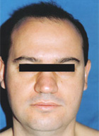 Antes del transplante capilar