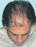 Antes del transplante capilar