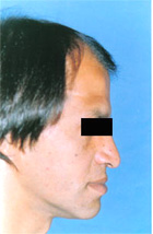 Antes del transplante capilar