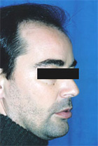 Antes del transplante capilar