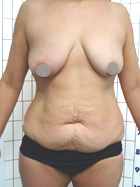 Antes Abdominoplastía