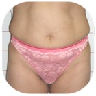 Antes abdominoplastia