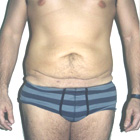 Antes Abdominoplastía