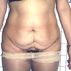 Antes Abdominoplastía