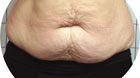 Antes Abdominoplastía