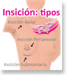 Tipos de insición para Aumento Mamario