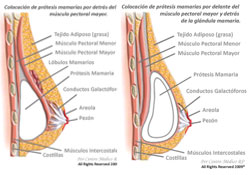 Protesis mamarias por delante o detrás, click para agrandar