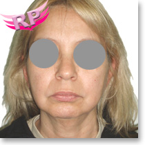 Antes del Lifting cervico facial