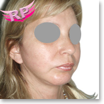 Después del Lifting cervico facial