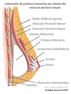 Colocación de prótesis mamarias por detrás del músculo pectoral mayor