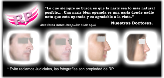 Rinoplastia Fotos antes-después