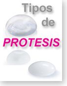 Tipos de prótesis mamarias