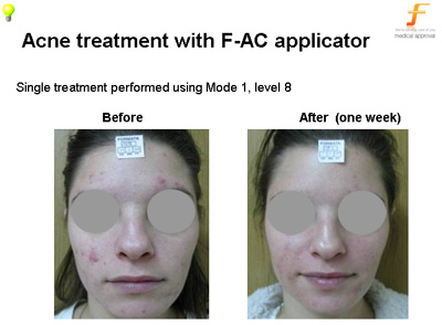 Luz pulsada online dermatología