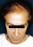Before Hair Transplant