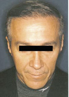 After Hair Transplant