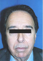 Before Hair Transplant