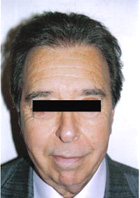 After Hair Transplant