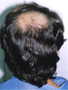 Before Hair Transplant