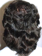 After Hair Transplant