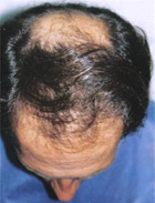 After Hair Transplant