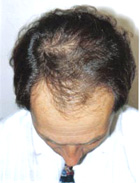 Before Hair Transplant
