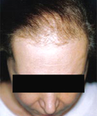 Before Hair Transplant