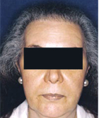 After Hair Transplant
