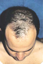 Before Hair Transplant