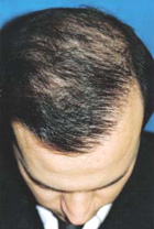 After Hair Transplant