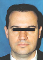 After Hair Transplant
