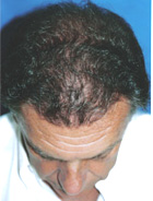 Before Hair Transplant