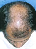 Before Hair Transplant