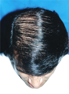 After Hair Transplant