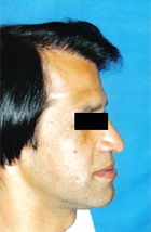 After Hair Transplant