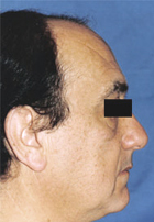 Before Hair Transplant