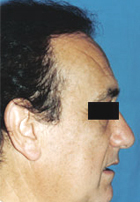 After Hair Transplant