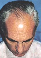 Before Hair Transplant