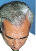After Hair Transplant
