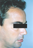 After Hair Transplant