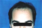 Before Hair Transplant