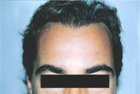After Hair Transplant