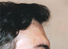 Before Hair Transplant